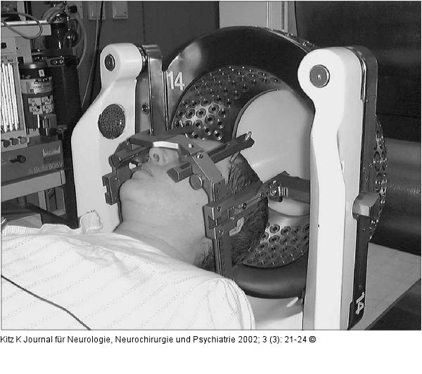 Gamma Knife - Innenkollimator