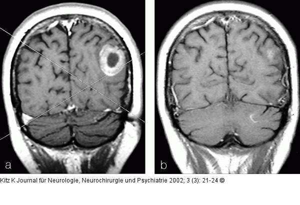 Hirnmetastase - Planungs-MRT für Gamma Knife