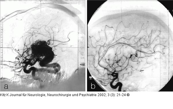 AV-Malformation - Planung für Gamma Knife