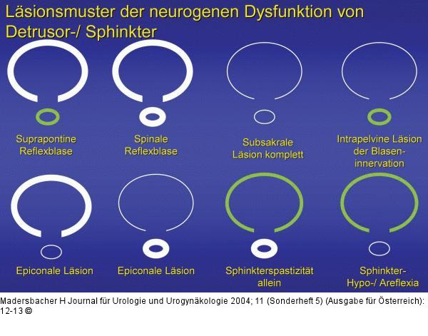 Neurogene Dysfunktion - Läsionsmuster