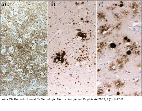 Spongiforme Enzephalopathie - Prionprotein