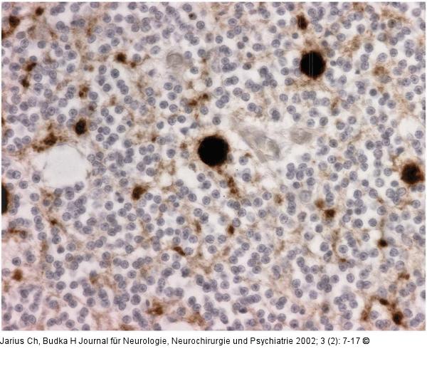 Spongiforme Enzephalopathie - Kuru - Prionprotein