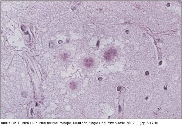 Spongiforme Enzephalopathie - vCJK - Prionprotein