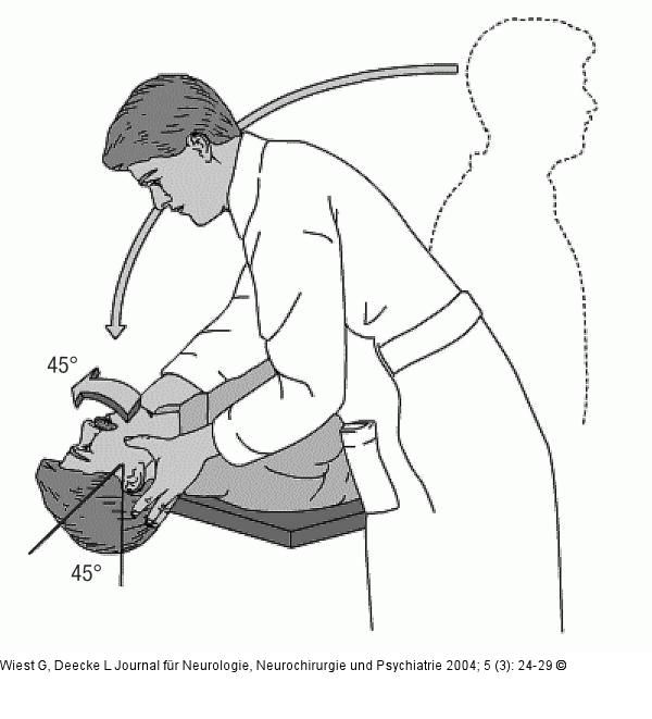 Dix-Hallpike-Manöver
