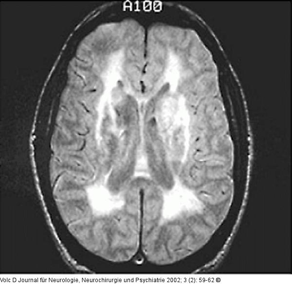 Morbus Binswanger - Demenz