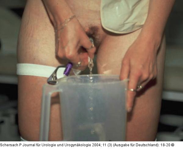 Intermittierender Selbstkatheterismus
