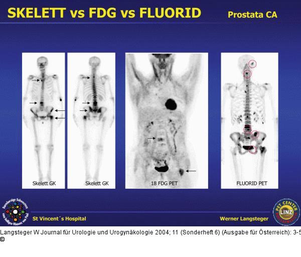 Fluorid-PET-CT