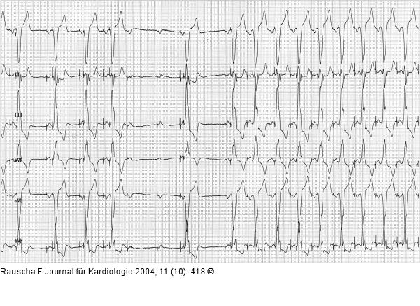 DDD-Schrittmacher-EKG