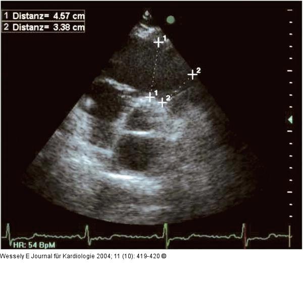 Parasternaler Längsschnitt - Parasternaler Querschnitt