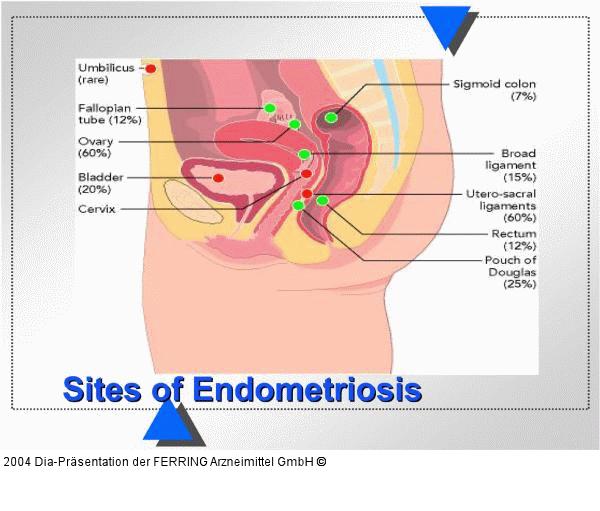 Endometriose