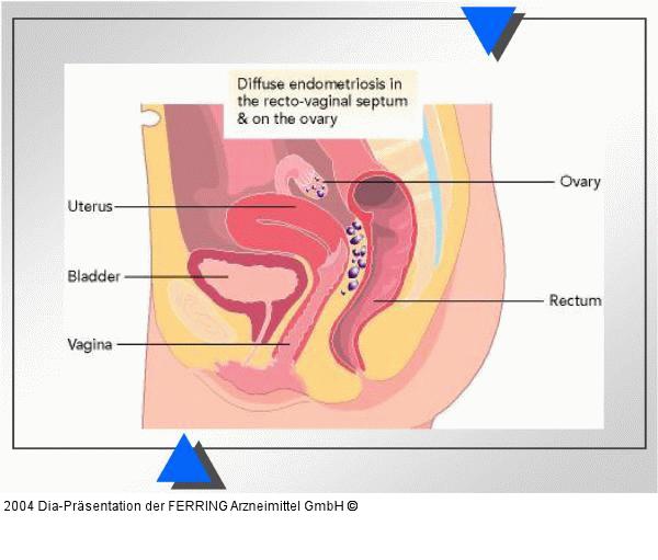 Endometriose