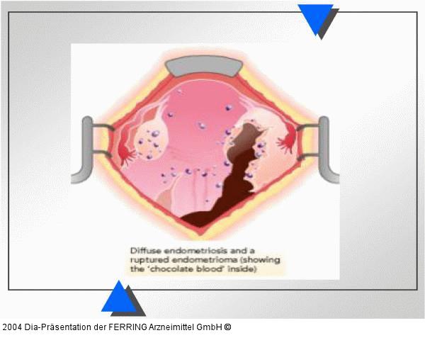 Endometriose