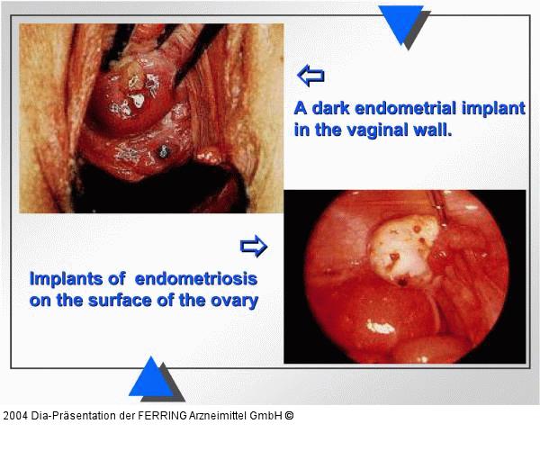 Endometriose
