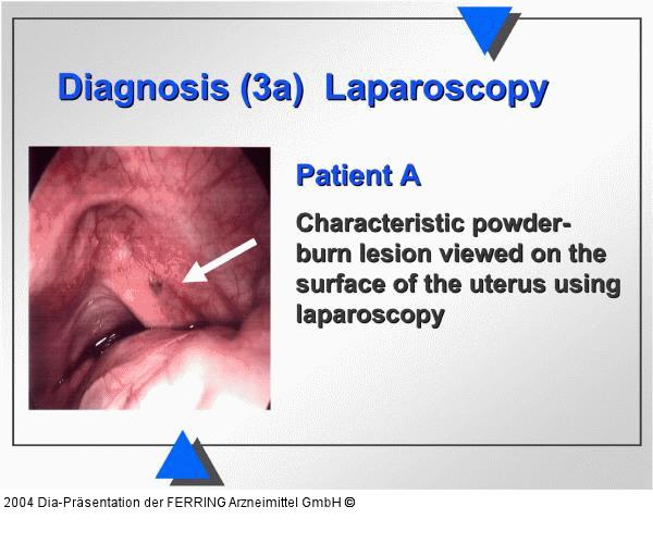 Diagnose - Laparoskopie