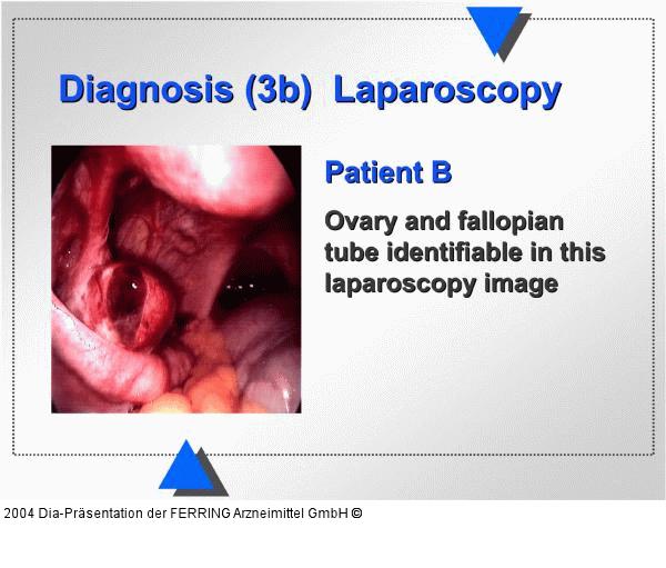 Diagnose  - Laparoskopie