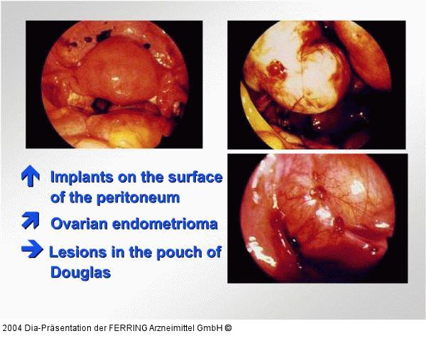 Endometriose