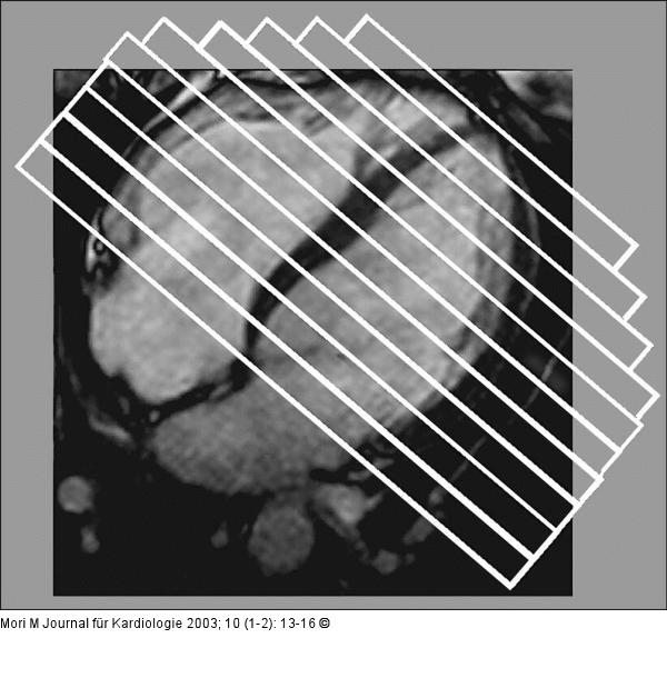 Kardiale Magnetresonanztomographie
