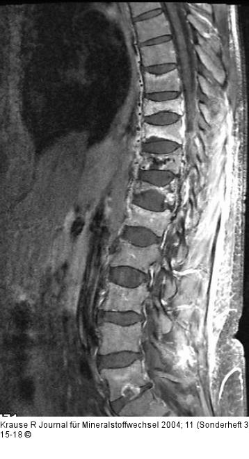 Wirbelkörper - Kompression