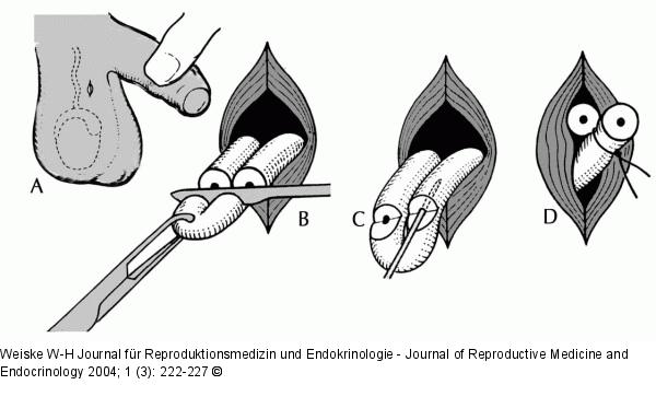 Minimal-invasive Vasektomie