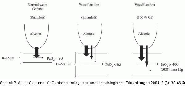 Diffusion - Perfusion - Impairment
