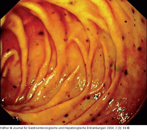 Pars descendens duodeni