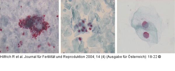 Zytologisches Abstrichpräparat - HPV-Infektion