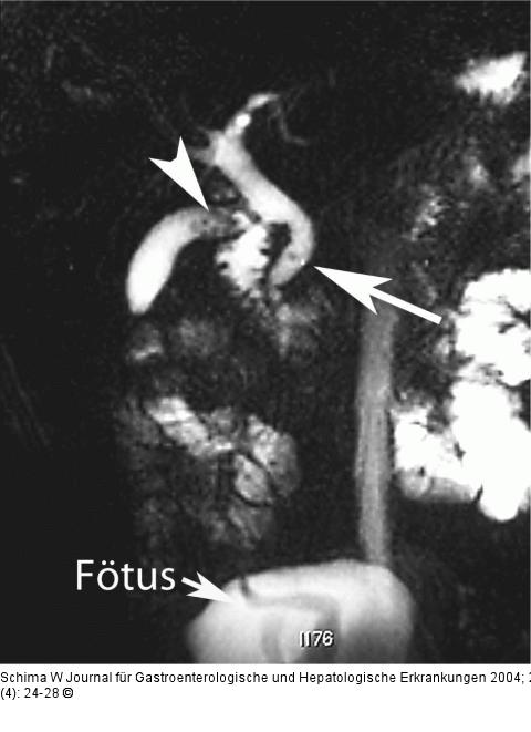 Biliäre Pankreatitis