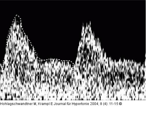 Arteria uterina - Dopplersonographie