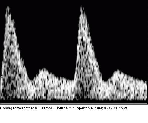 Arteria uterina - Dopplersonographie