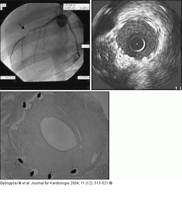 Arteria coronaria sinistra - Koronarangiographie