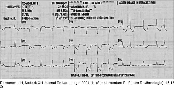 Normofrequentes Vorhofflimmern