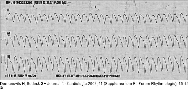 Ventrikuläre Tachykardie