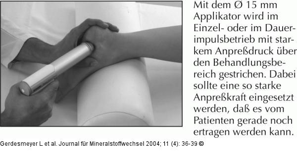 Radiale extrakorporale Stoßwellentherapie - Fersensporn