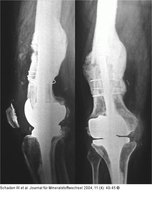 Kniegelenksprothese - ESWT