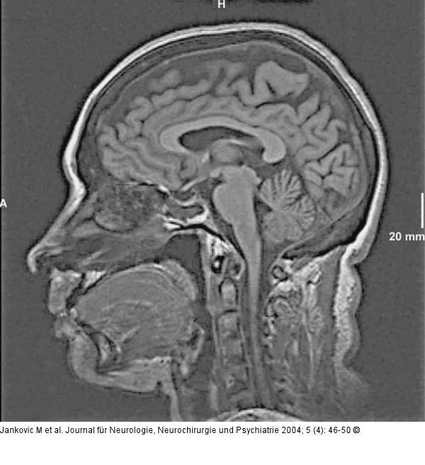 Epileptische Anfälle - intrathekale Fluoreszeinapplikation