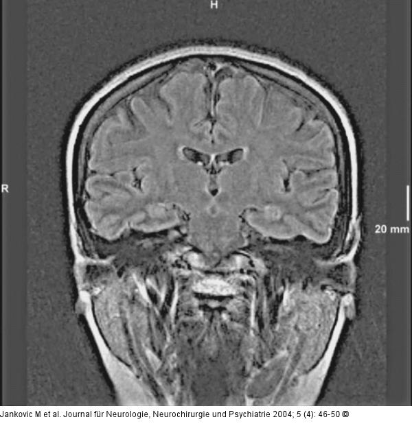 Epileptische Anfälle - intrathekale Fluoreszeinapplikation