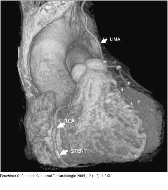 Bypässe - Volume Rendering Technique (VRT)