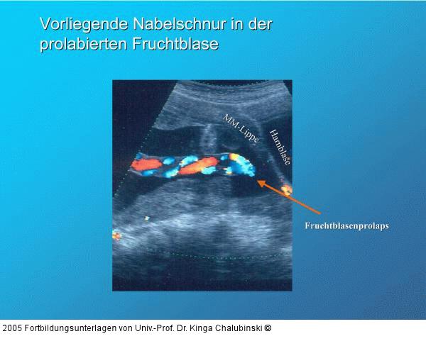 Vorliegende Nabelschnur