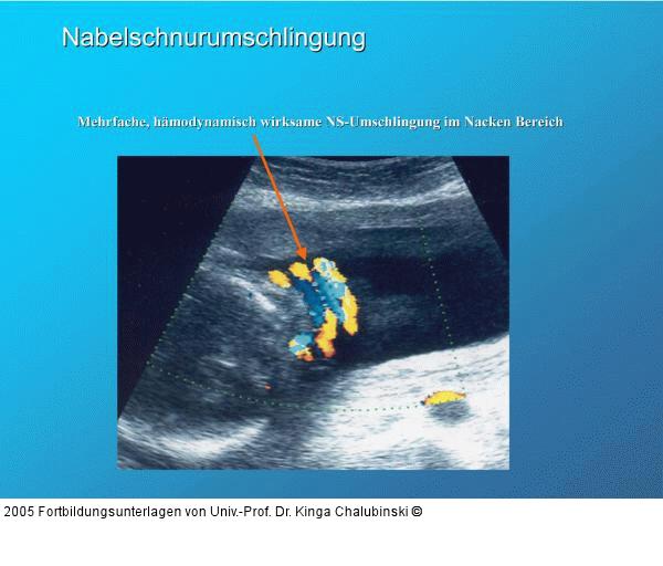 Nabelschnurumschlingung