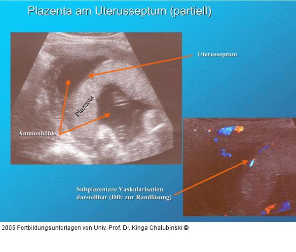 Plazenta am Uterusseptum (partiell)