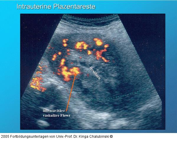 Intrauterine Plazentareste