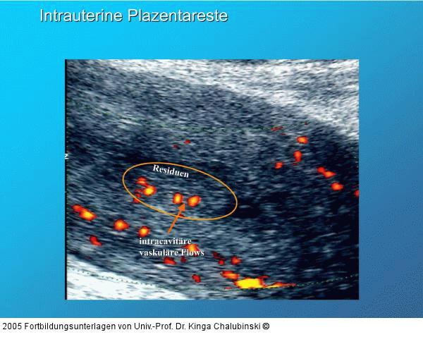 Intrauterine Plazentareste