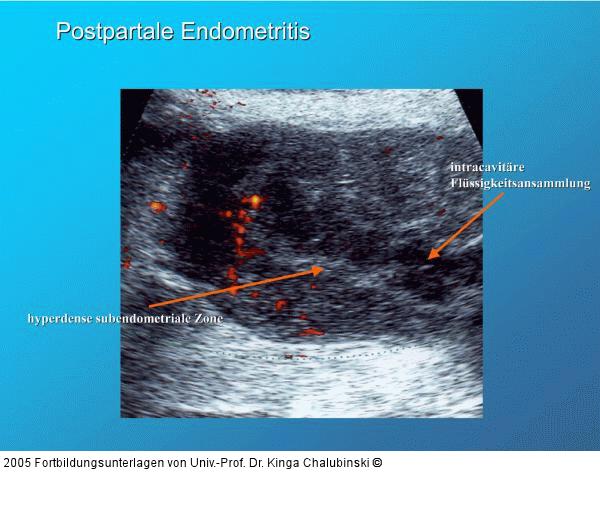 Postpartale Endometritis