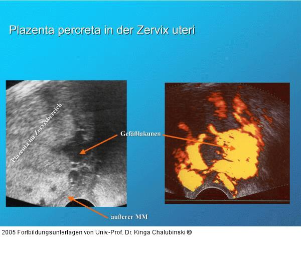 Plazenta percreta - Zervix uteri