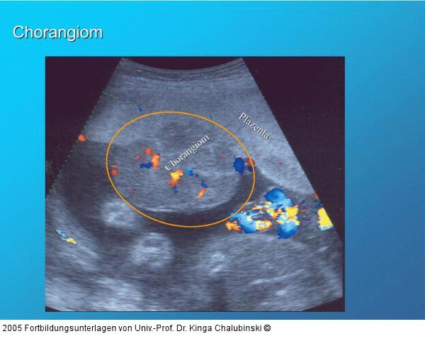 Chorangiom