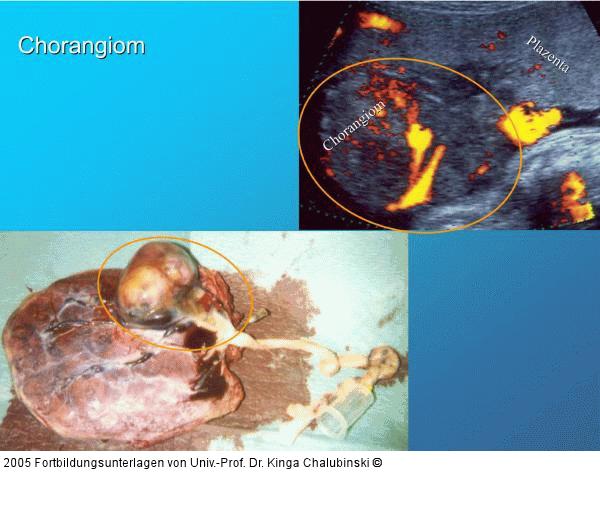 Chorangiom