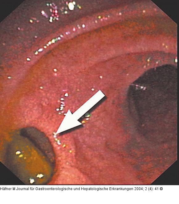 Choledochoduodenostomie
