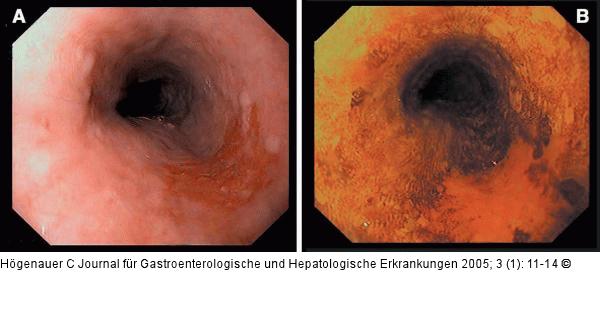 Plattenepithelfrühkarzinom - Mukosa - Lugol'sche Lösung