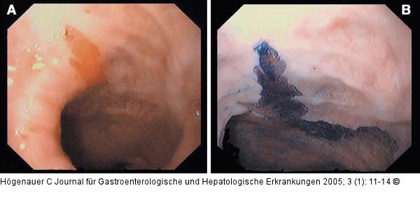 Short segment-Barrettösophagus - Methylenblau