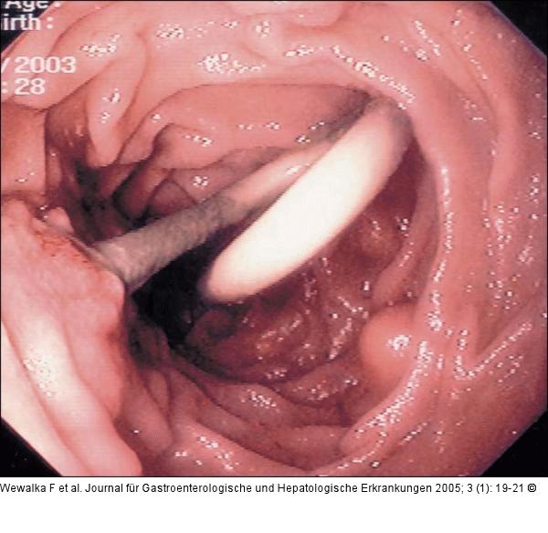 Pigtail-Prothese - Papilla Vateri
